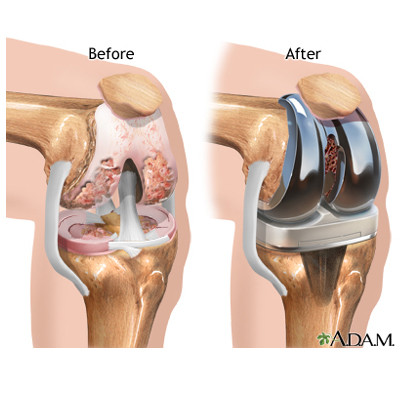 KNEE JOINT REPLACEMENT-(Apollo Hospital): $3000